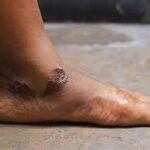 நீரிழிவு நோயாளர்கள் காலில் புண்கள் ஏற்பட்டால் செய்ய வேண்டியவை