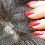 சமையலறையிலேயே பொடுகு தொல்லைக்கு தீர்வுகள்