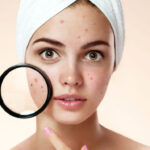 முகப்பருவை நீக்க உங்களுக்கான வழிகள் இதோ!!!