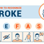 பக்கவாதத்தின் அறிகுறிகள் சிலவற்றை முன்கூட்டியே தெரிந்து கொள்வோம்