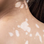 வெண்குஷ்டம் நோயால் அதிகம் பாதிக்கப்படும் பெண்கள்