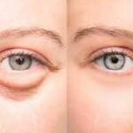 கண்களின் கீழ் வரும் வீக்கத்தை தடுக்க எளிய வழிமுறைகள் !